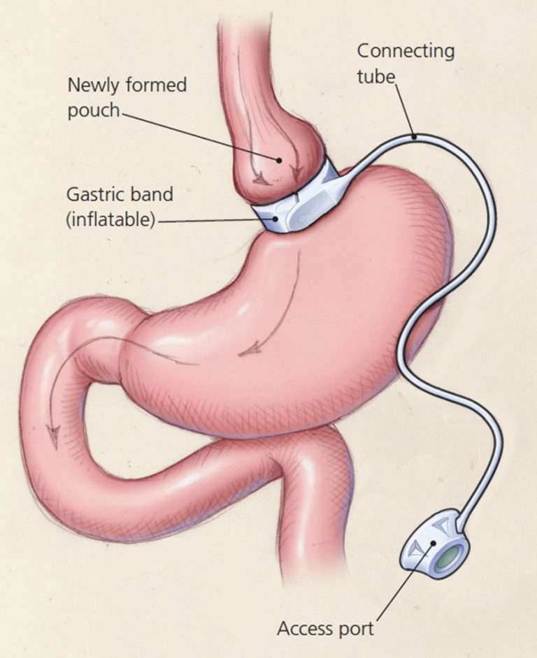 Adjustable-Gastric-Banding-835x1024