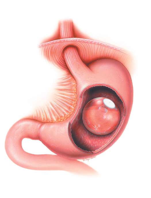 Gastric Ballooning 1