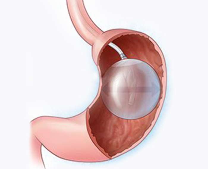 Endoscopic Intragastric Balloon - Weight Loss Treatment By Cosmetique
