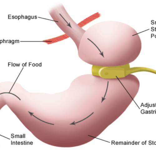 671-adjustable-gastric-banding_full 671-adjustable-gastric-banding_full