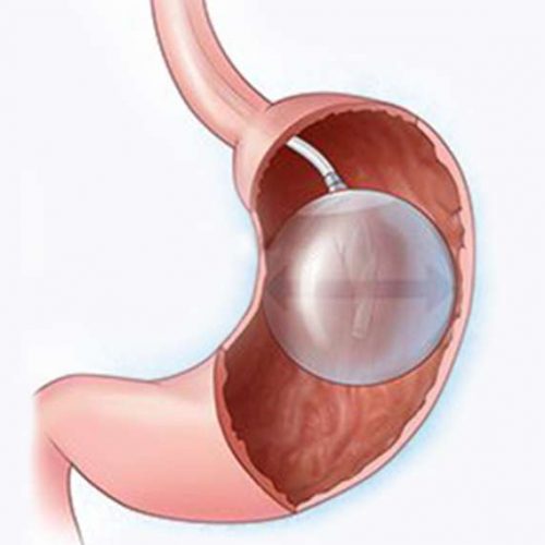 intragastric-balloon-obesity-treatment-surgery-gastric-lost-weight